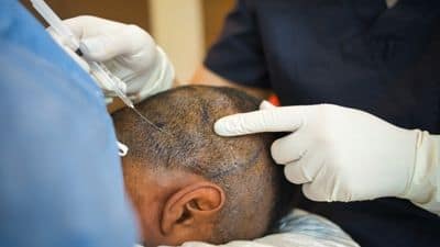Hair transplant cost in India