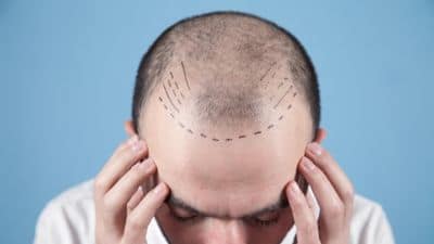 Hair transplant cost in India