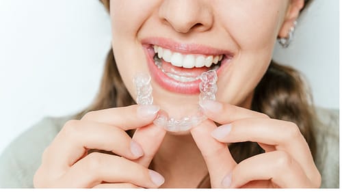 Braces vs Aligners by morningsun