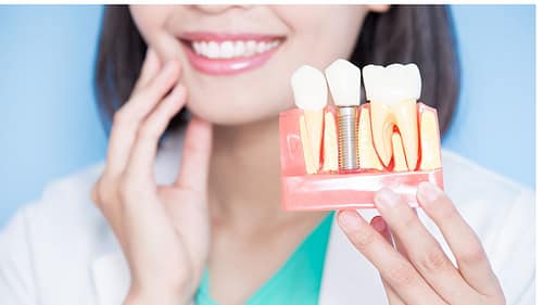 dental implants by morningsun