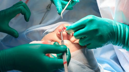 rhinoplasty in India by morningsun