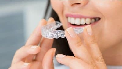 Braces vs Aligners